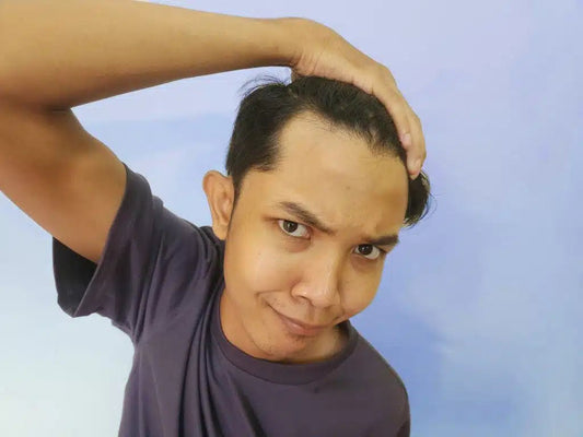 Caída del cabello en hombres jóvenes: por qué ocurre y qué hacer antes de que sea tarde