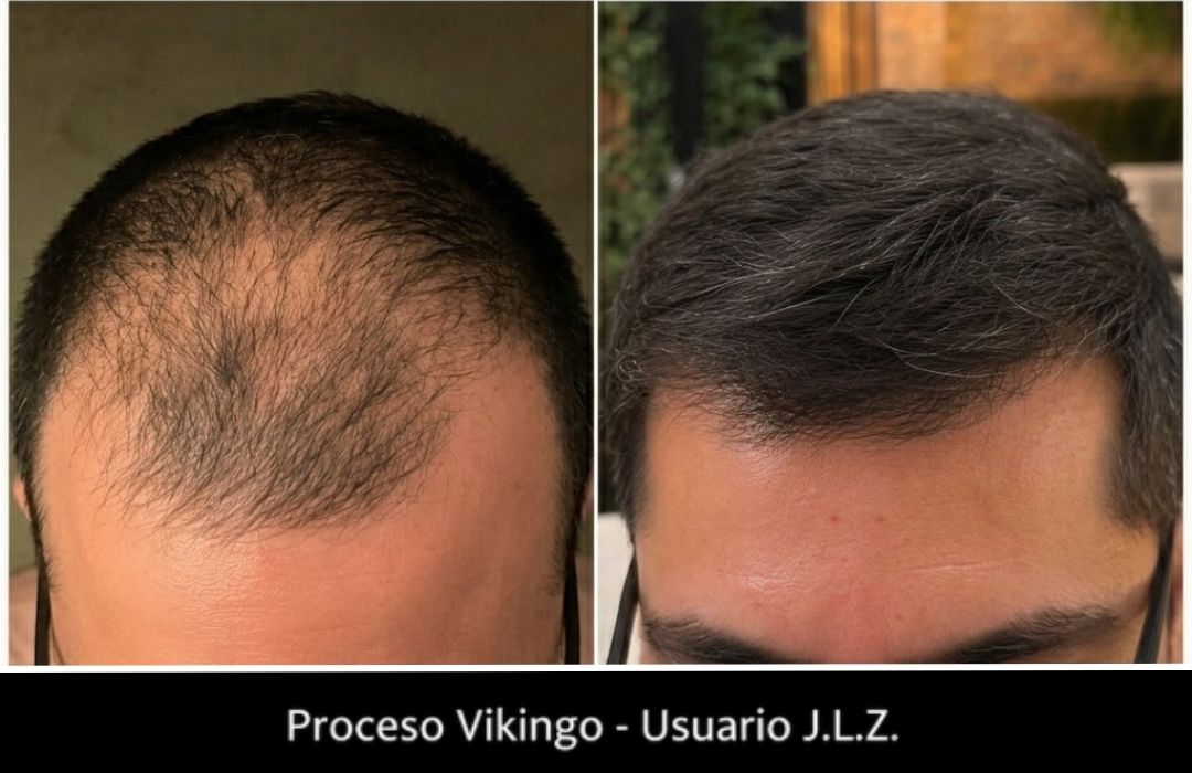 Por qué se me cae el cabello: causas y tratamiento real